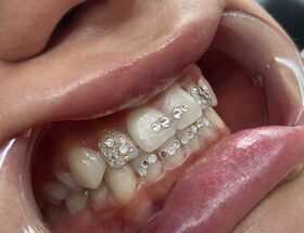 Toothgems