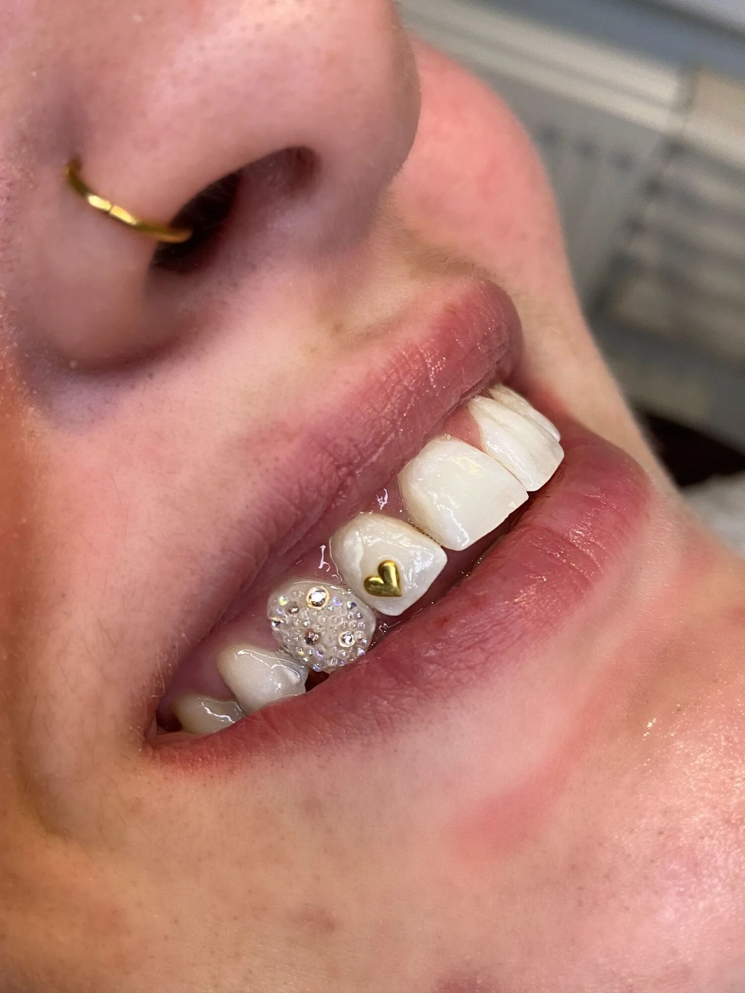 Toothgems