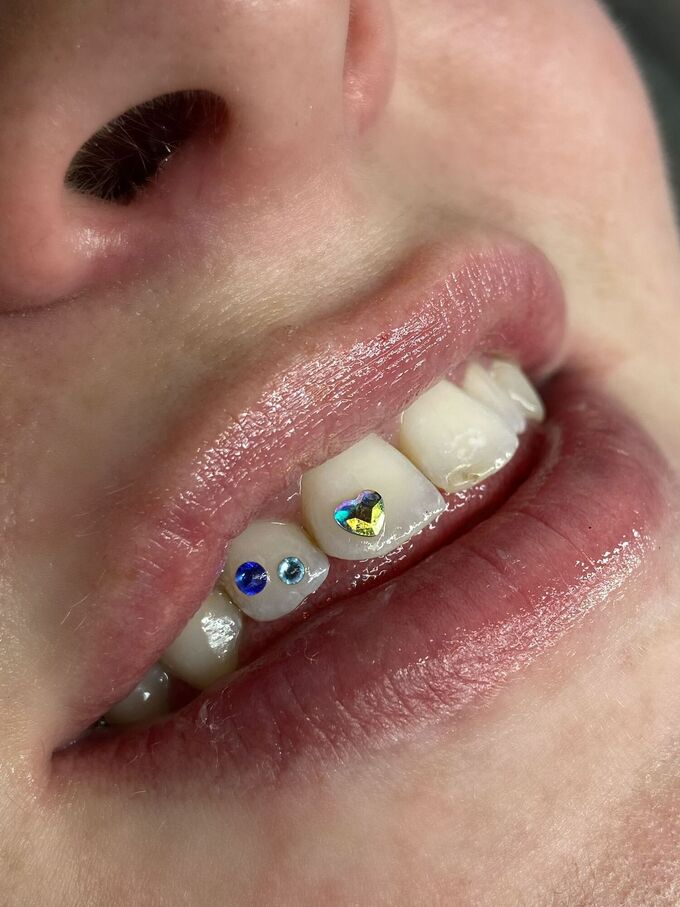 Toothgems