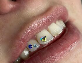 Toothgems