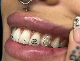 Toothgems