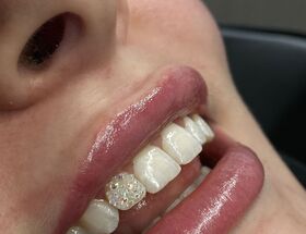 Toothgems